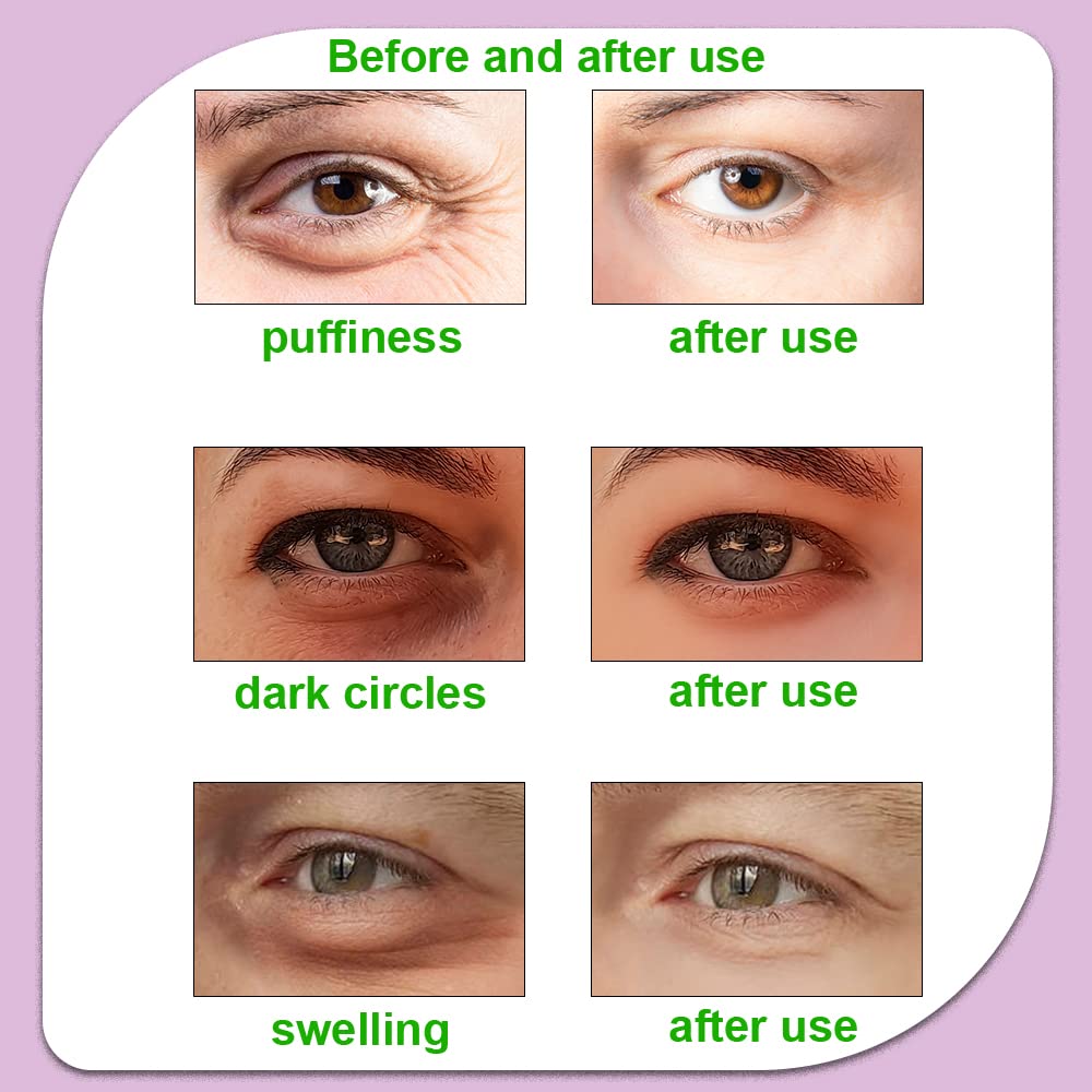 4PCS Gel Eye Ice Pack Set Reusable, Cold and Hot Compress for Eyes, Ice Pack for Eyes, Cooling Eye Pads for Eye Strain, Swelling, Redness, Dark Circles, Puffy Eyes, and Eye Recovery Surgery.
